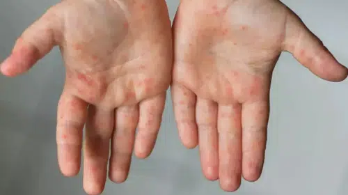 Endonezya'da Kızamık Salgını: 17 Kişi Hayatını Kaybetti