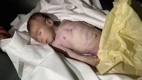 İsrail, Gazze Şeridi'nde Açlık Nedeniyle 5 Filistinliyi Daha Kaybetti